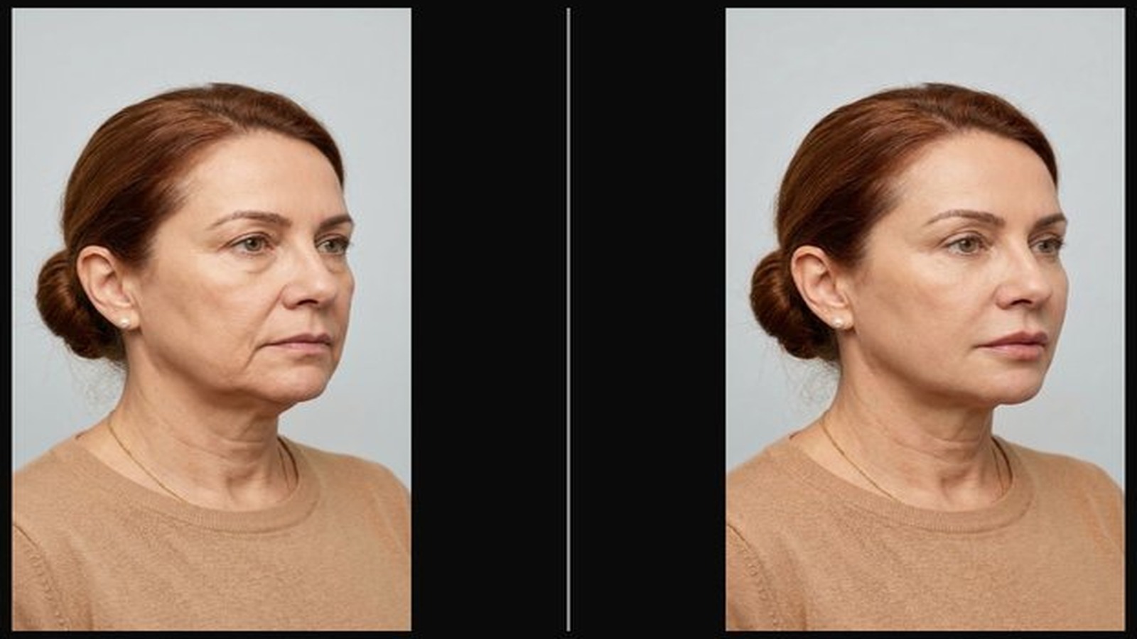 Comparativo ilustrativo antes e após simulação de harmonização facial no Face Plan™